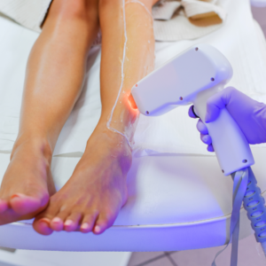 Épilation laser